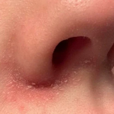 Popper Nose Burn